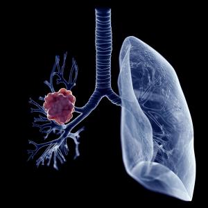 First-line benmelstobart–anlotinib combo yields PFS gain in advanced PD-L1-positive NSCLC