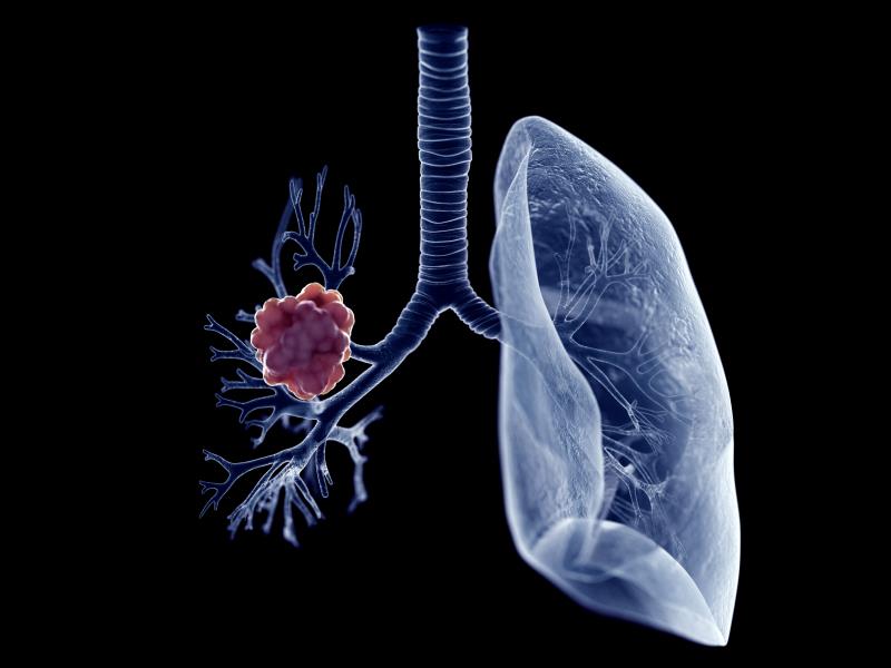 First-line benmelstobart–anlotinib combo yields PFS gain in advanced PD-L1-positive NSCLC