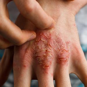 Adalimumab delivers consistent benefit in plaque psoriasis, with or without methotrexate