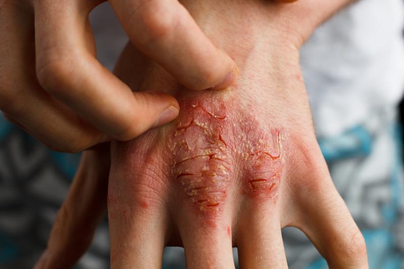 Adalimumab delivers consistent benefit in plaque psoriasis, with or without methotrexate