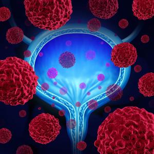 Gemcitabine for IR-NMIBC tied to more recurrence vs BCG