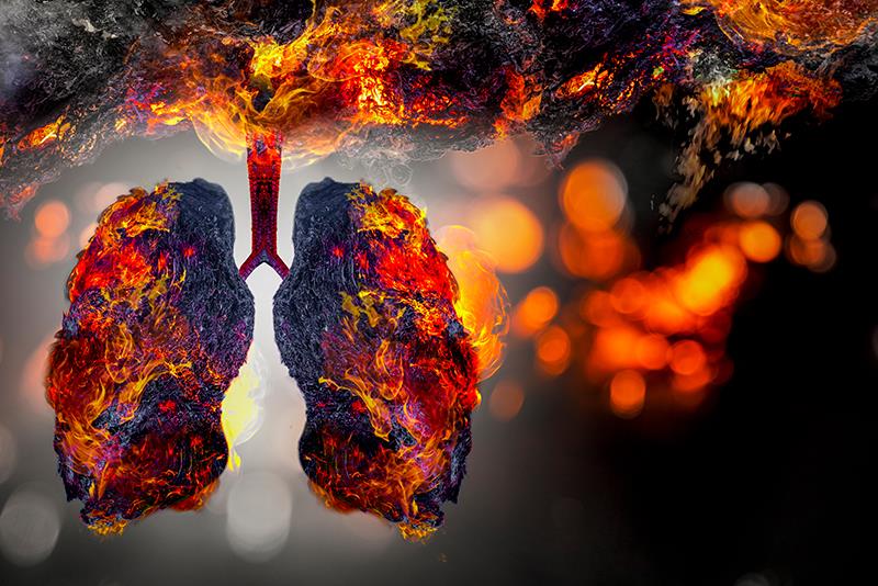 Ultrathin bronchoscopy boosts small airway biopsy potential for diagnosing sarcoidosis