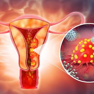 Selinexor maintenance shows consistent benefit in TP53wt endometrial cancer