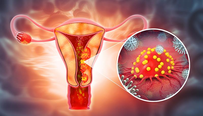 Selinexor maintenance shows consistent benefit in TP53wt endometrial cancer