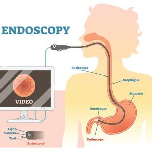 Early detection of stomach and oesophageal cancers calls for early symptom recognition