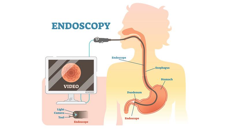 Endoscopic procedures such as gastroscopy and colonoscopy have significantly improved the ability to diagnose and treat gastr