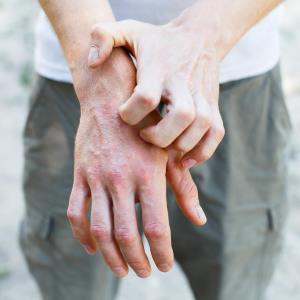 Specific vitamins may curb atopic dermatitis risk in young Chinese adults