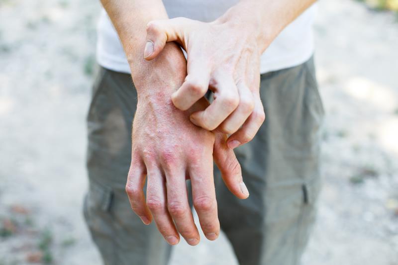 Higher dietary intake of vitamins E, K1, C, B2, and D appears to mitigate the risk of atopic dermatitis in young Chinese adul