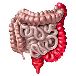 Plant-based fasting-mimicking diet does not boost medication response in UC