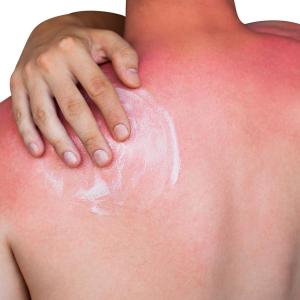 Painful, blistering, severe sunburns tied to cutaneous squamous cell carcinoma