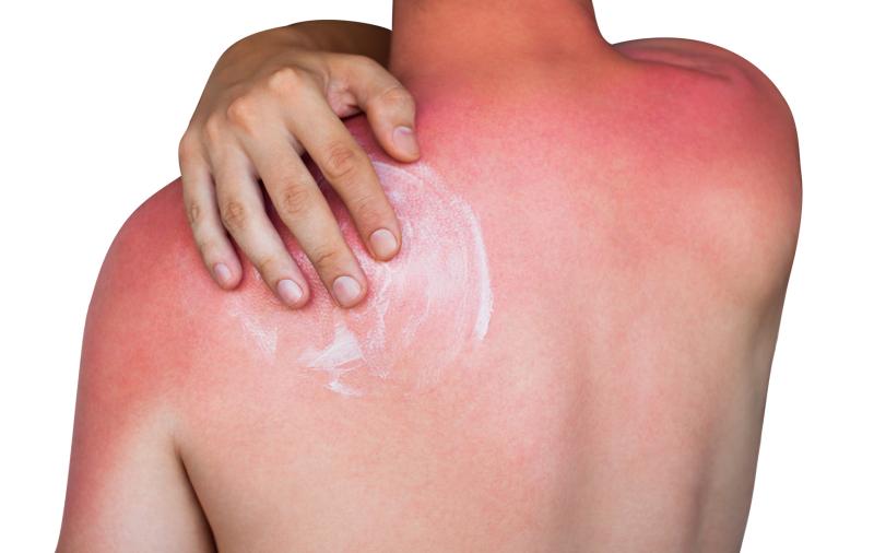 Sunburn rashes could develop into blisters