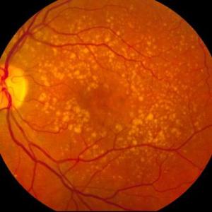 HDL levels linked to AMD risk
