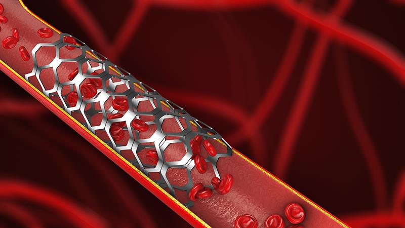 FUTURE-III trial reinforces potential of thinner-strut BRS for CAD