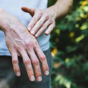 Adult-onset Still’s disease outcomes better with frontline biological vs csDMARD therapy