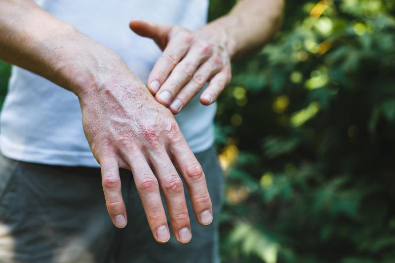 Adult-onset Still’s disease outcomes better with frontline biological vs csDMARD therapy