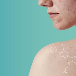 Trifarotene: Acne Relieve by Modern Retinoid Molecule