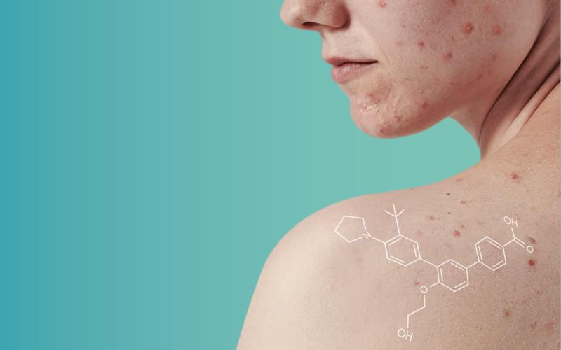 Trifarotene: Acne Relief by Modern Retinoid Molecule