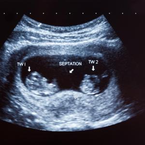 Antenatal betamethasone lowers risk of respiratory morbidity in late preterm twin neonates