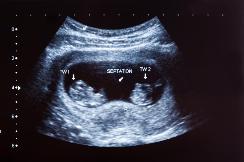 Antenatal betamethasone lowers risk of respiratory morbidity in late preterm twin neonates