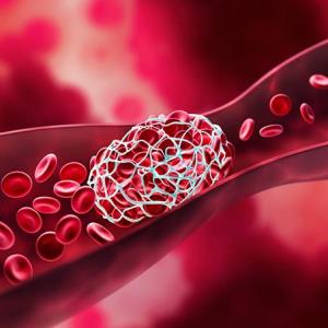 VTE event risk up in PD patients