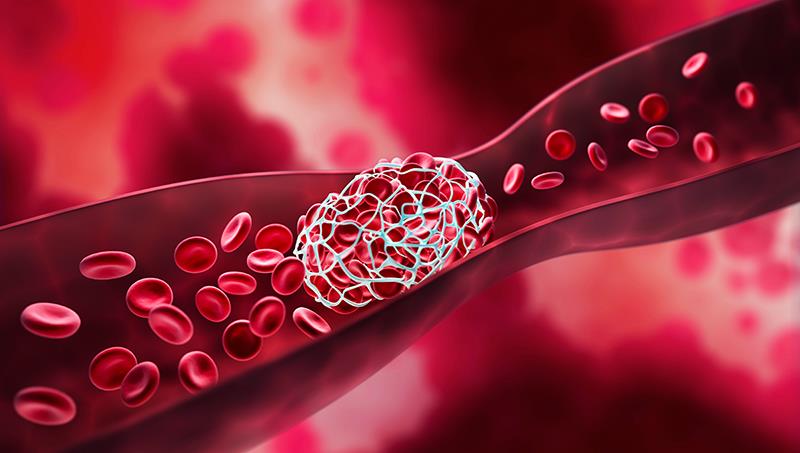 VTE event risk up in PD patients