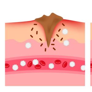 Enoxaparin, nadroparin help accelerate wound healing
