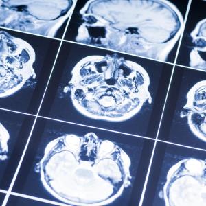 Awake craniotomy feasible, safe in patients with drug-resistant focal epilepsy