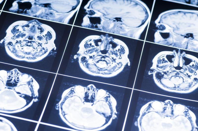 Awake craniotomy feasible, safe in patients with drug-resistant focal epilepsy