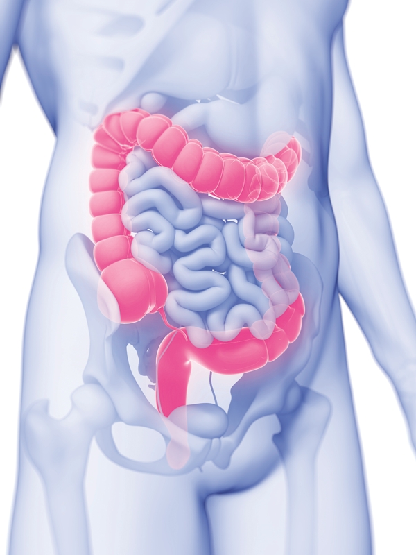 Diverticulitis