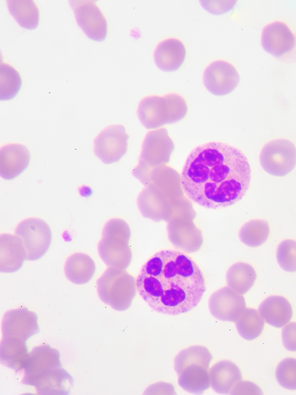Febrile Neutropenia