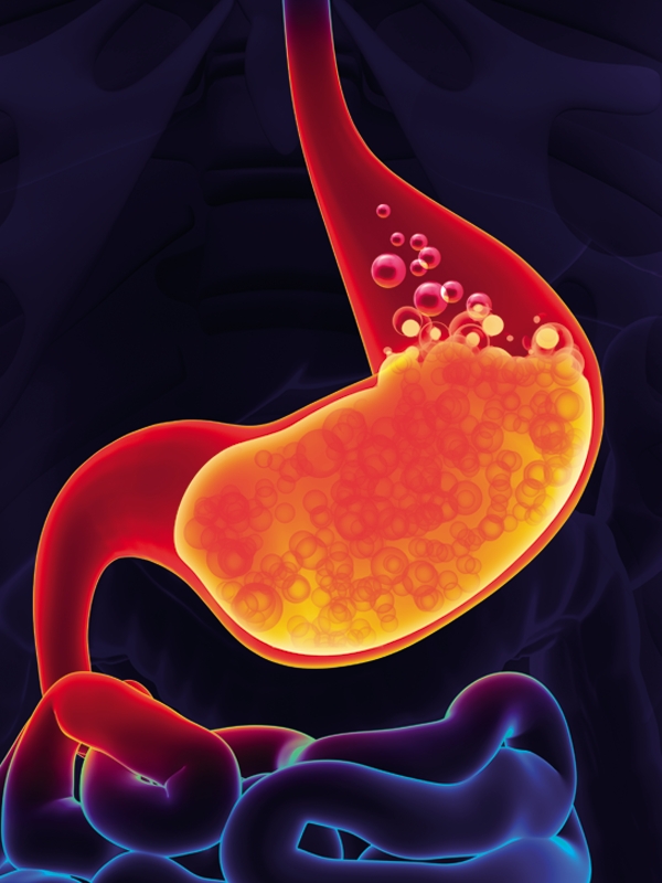 Bệnh trào ngược dạ dày ở trẻ em