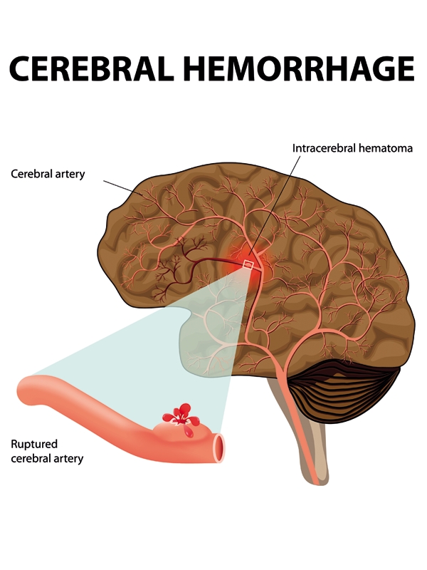 Intracerebral Hemorrhage