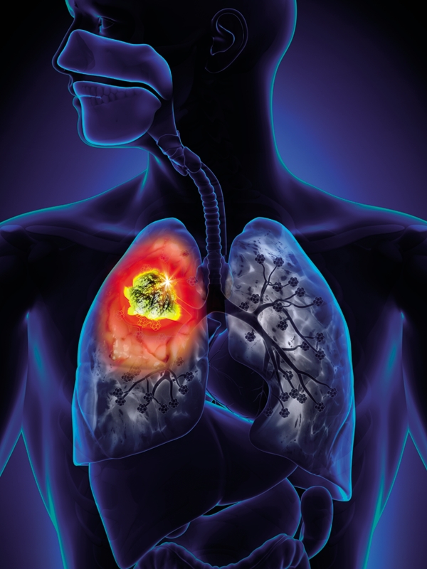 Lung Cancer