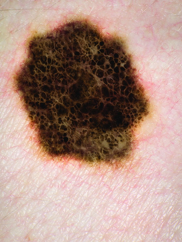 Melanoma
