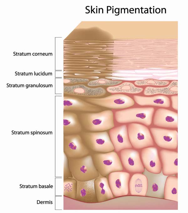 Melasma