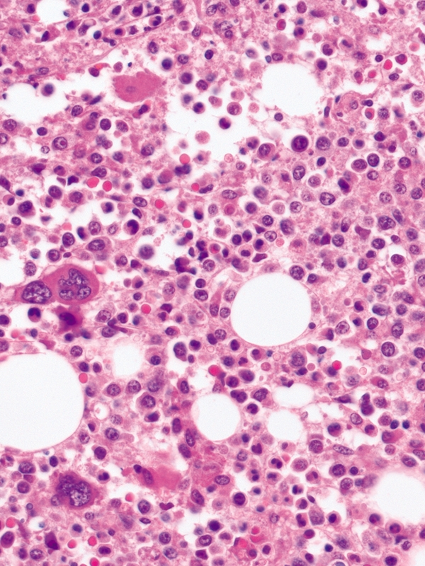 Multiple Myeloma