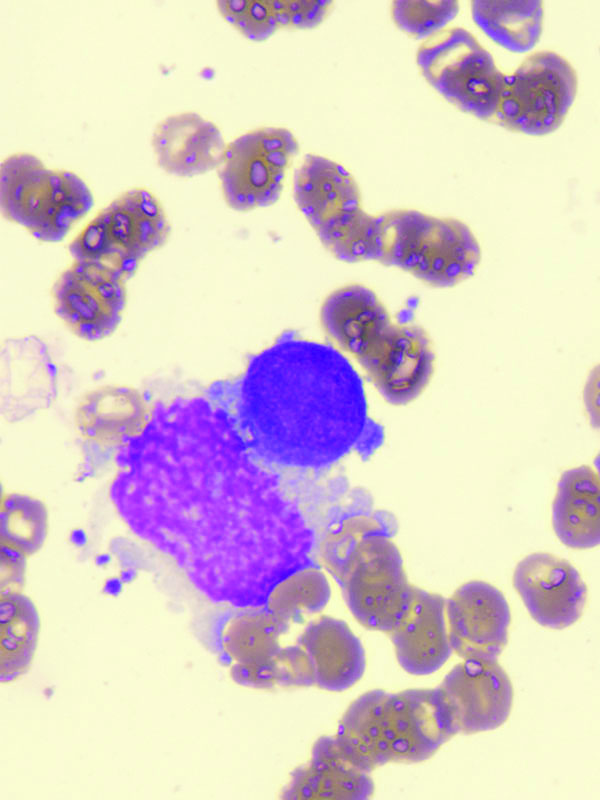Myelofibrosis