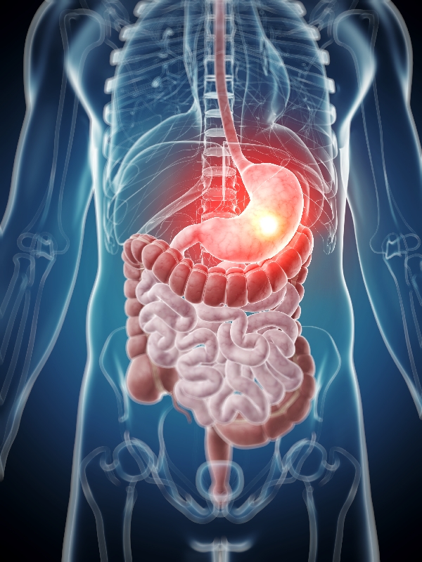 Peptic Ulcer Disease
