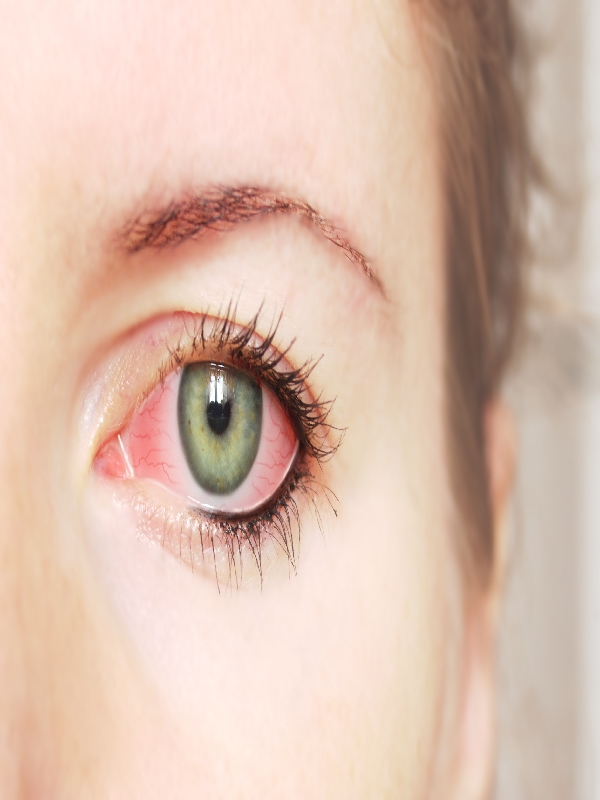 Primary Angle-Closure Glaucoma