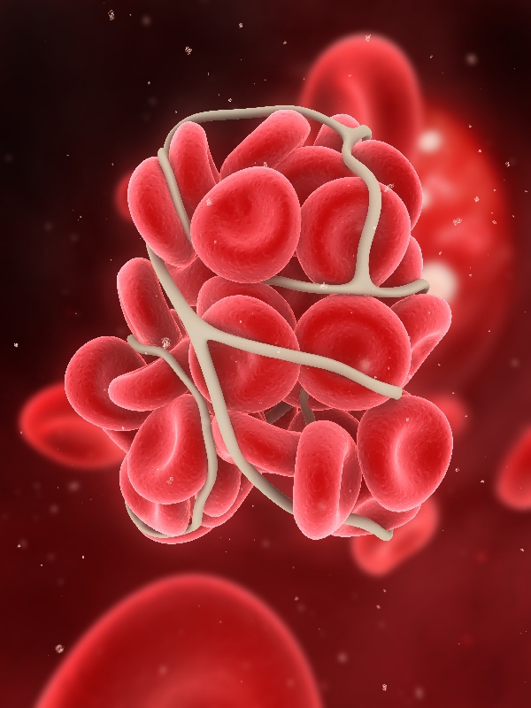 Pulmonary Thromboembolism
