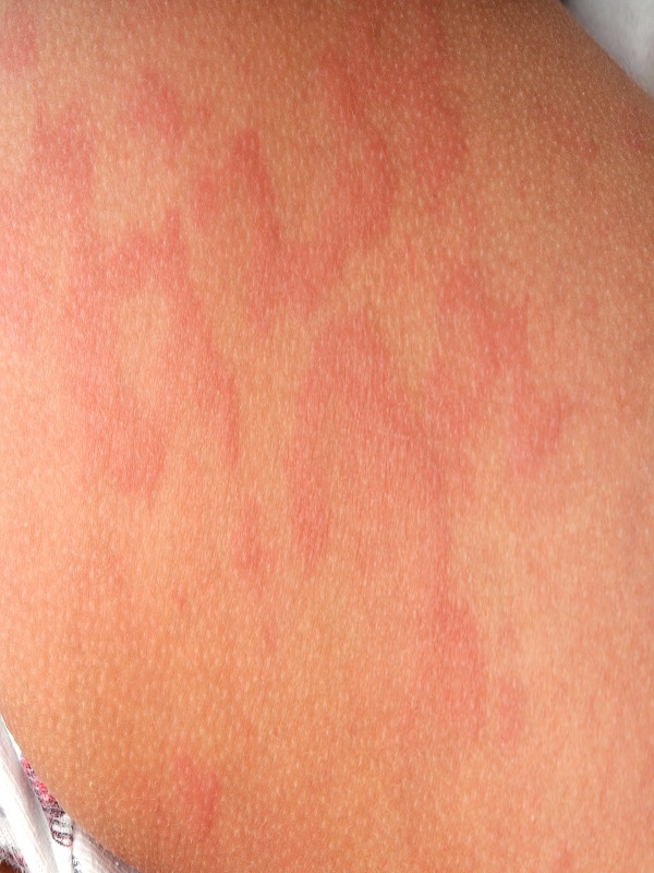 Urticaria