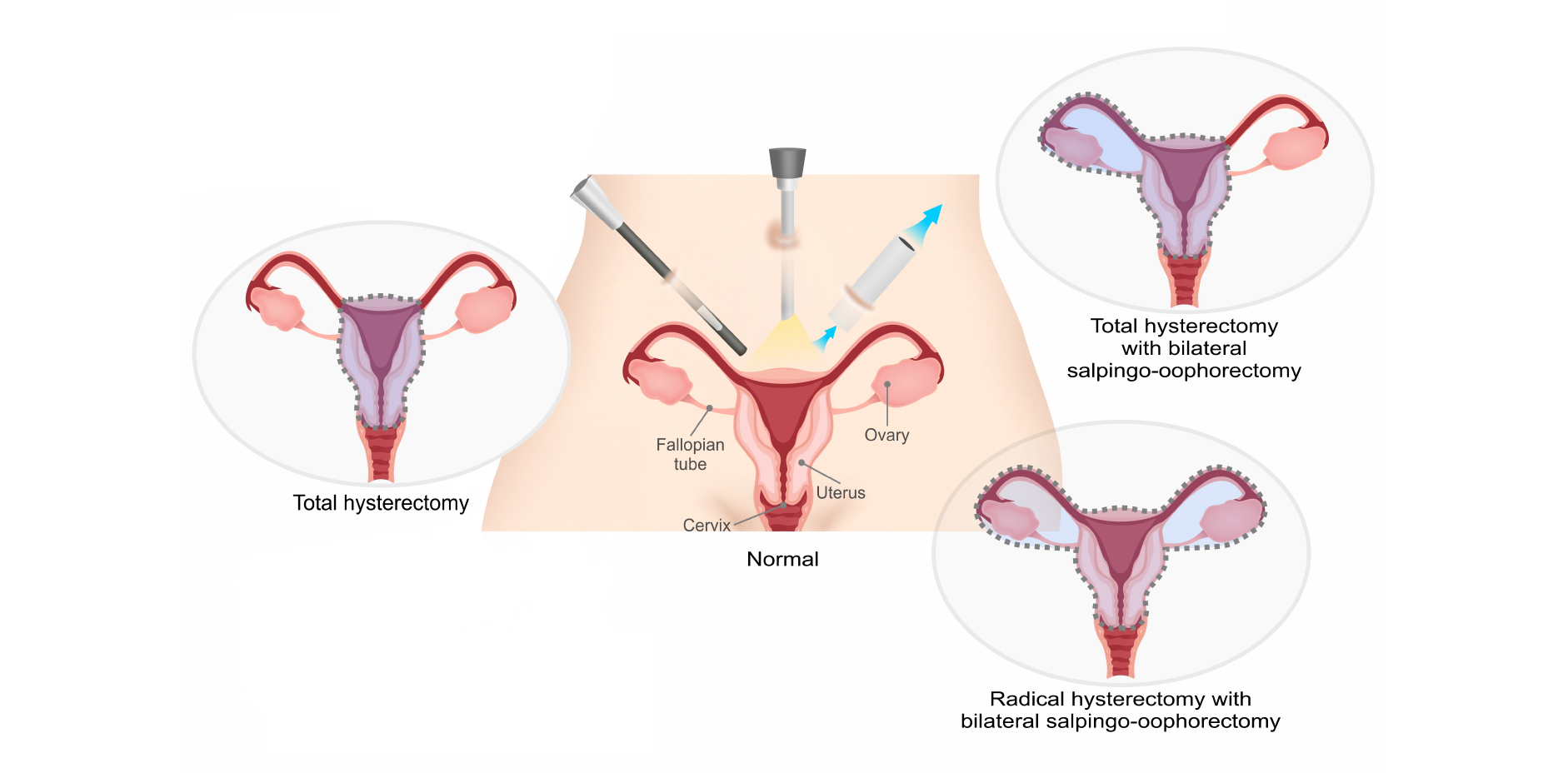 Endometriosis_Management2