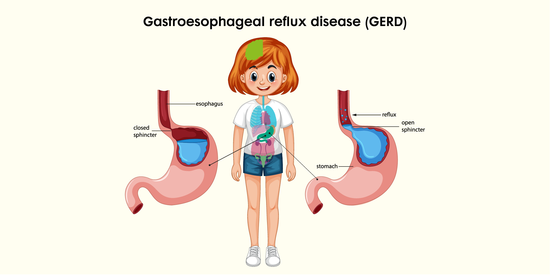 Gastroesophageal Reflux Disease (GERD) in Children : Disease Background ...