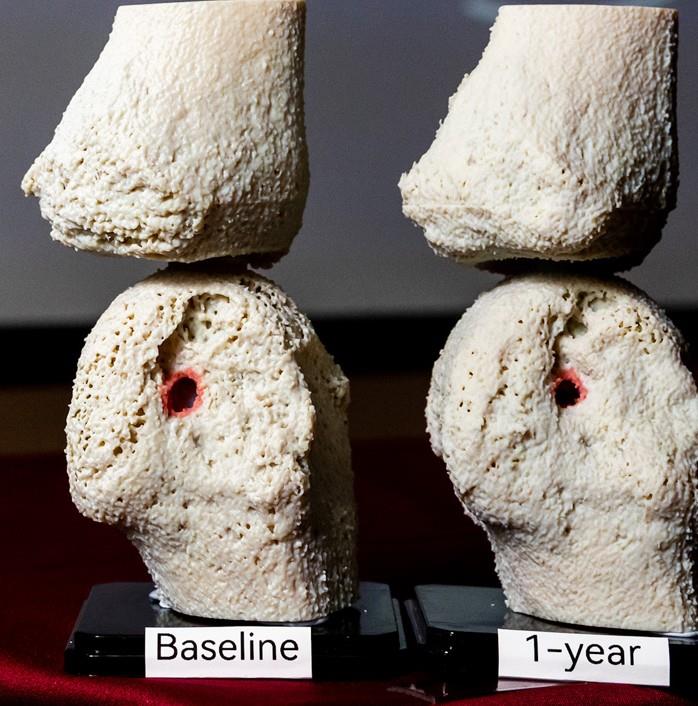 3D bone model: Partial healing of bone erosion after 1 year of secukinumab treatment