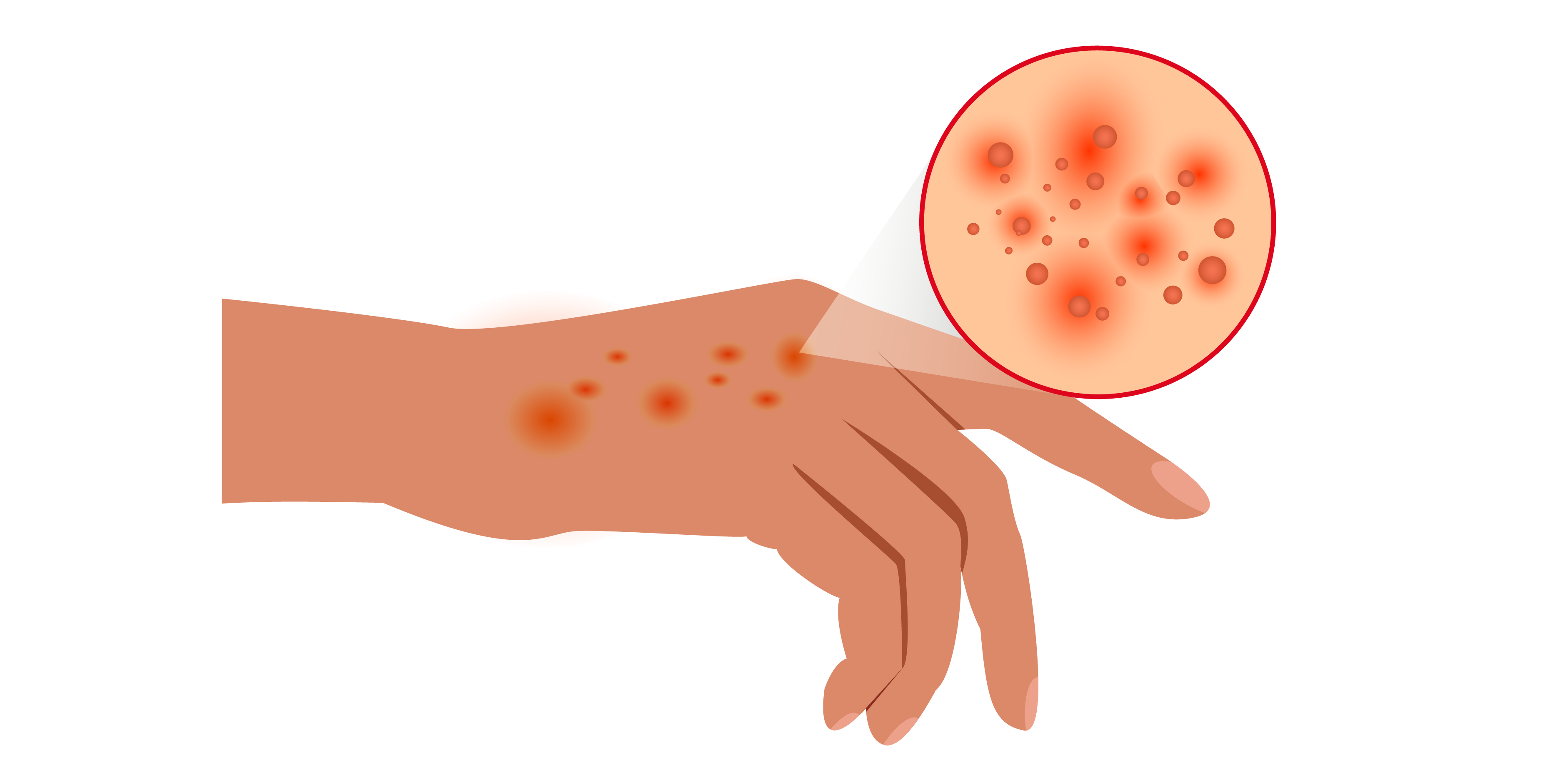 Atopic Dermatitis : Disease Summary | MIMS Indonesia