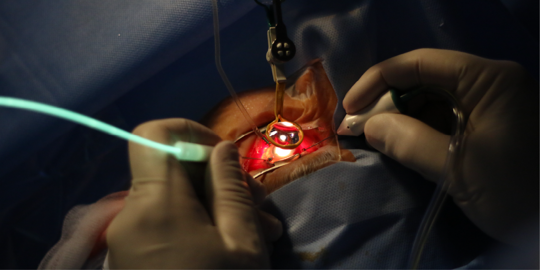 Diabetic Retinopathy_Management 4