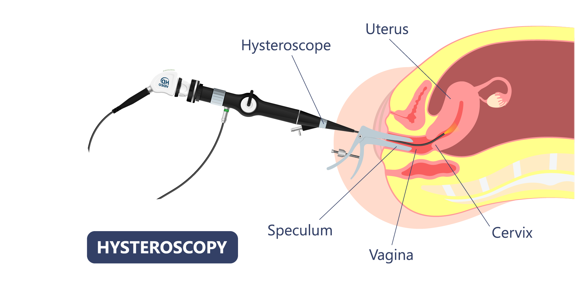 Infertility_Diagnostics 3