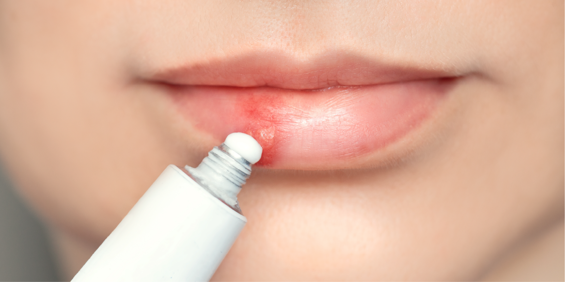Herpes Simplex Virus Infection_Management 2