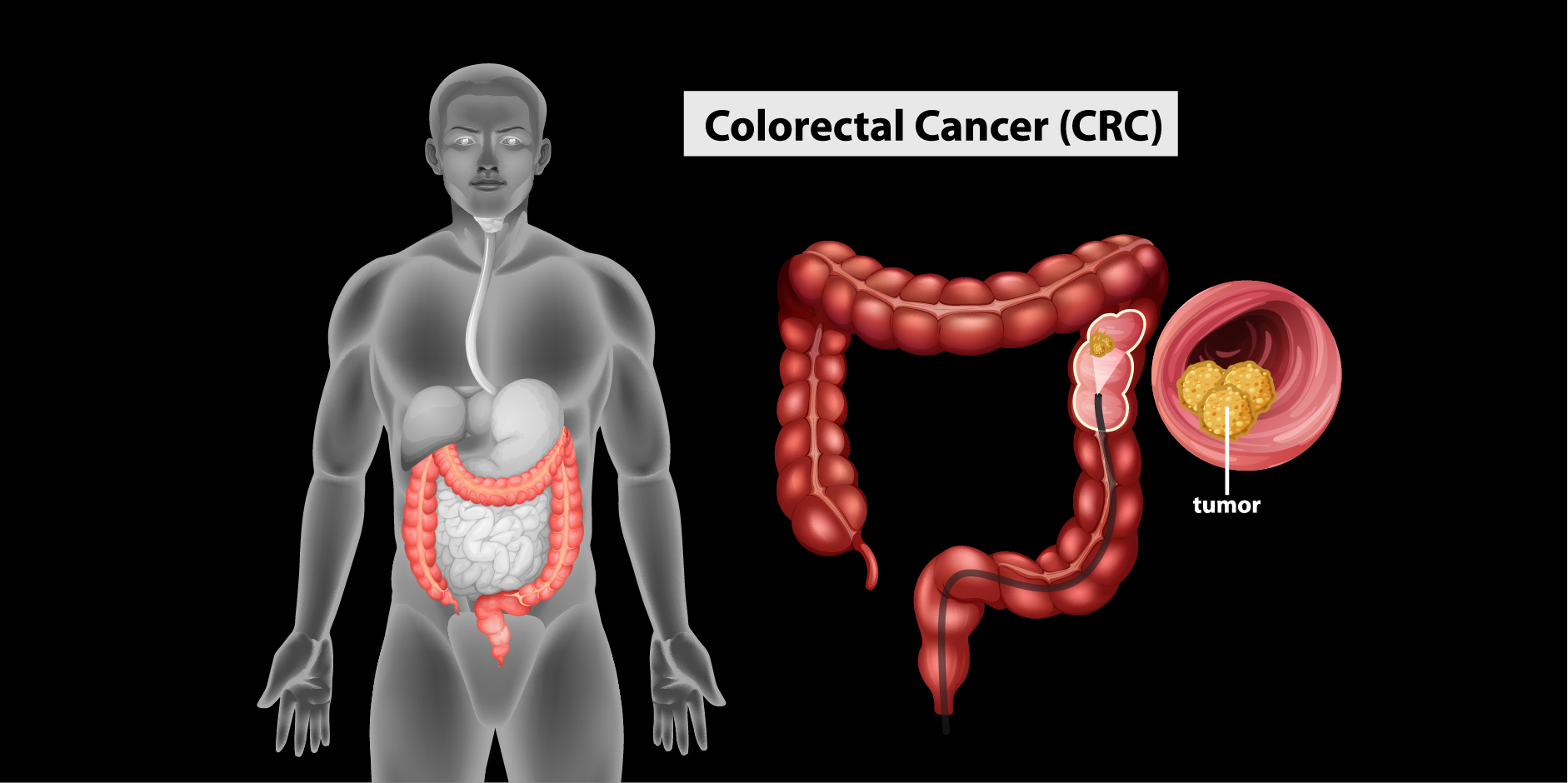Inflammatory Bowel Disease_Follow Up