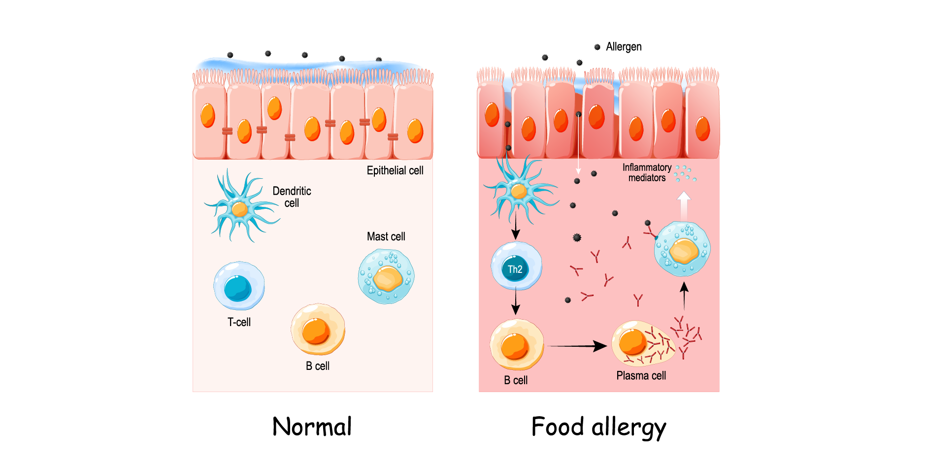 Food Allergy (Pediatric)_Disease Background 2